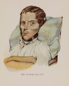 Man suffering from pulmonary tuberculosis. Illustration from Kranken-Physiognomik / by von K. H. Baumgärtner / 1929. Credit: Wellcome Collection